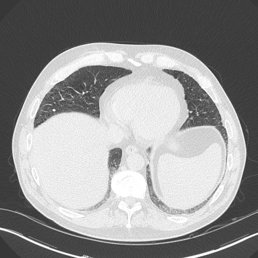 Caplan syndrome (Radiopaedia 56667-63530 Axial lung window 150).jpg