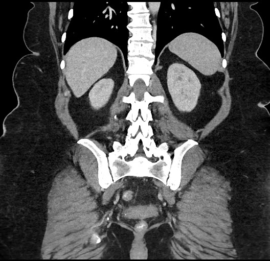 Carcinoid tumor - terminal ileum (Radiopaedia 60931-68739 B 75).jpg