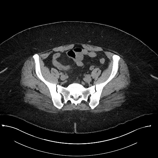 Carcinoid tumor - terminal ileum (Radiopaedia 60931-68740 Axial non-contrast 91).jpg