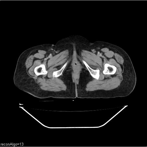 Carcinoma cervix- recurrence (Radiopaedia 34702-36137 B 56).jpg
