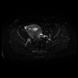 Carcinoma of the cervix (Radiopaedia 89018-105858 Axial DWI 17).jpg