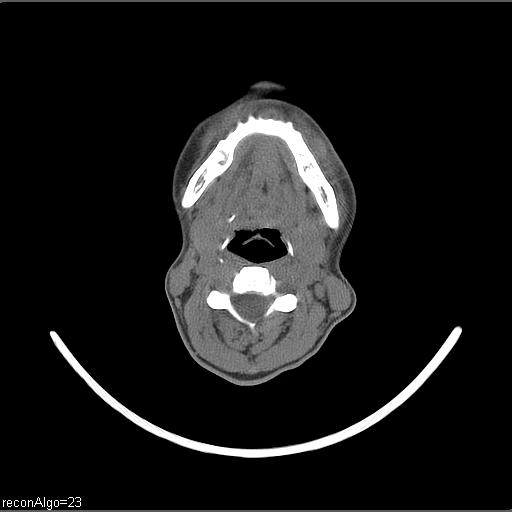 Carcinoma of the maxillary antrum (Radiopaedia 53805-59888 Axial non-contrast 37).jpg