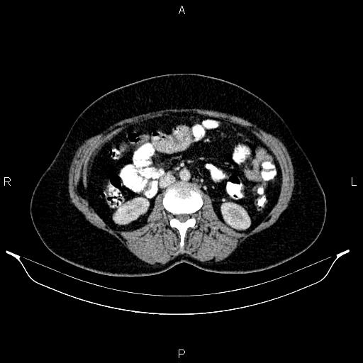 Carcinoma of uterine cervix (Radiopaedia 85861-101700 A 48).jpg