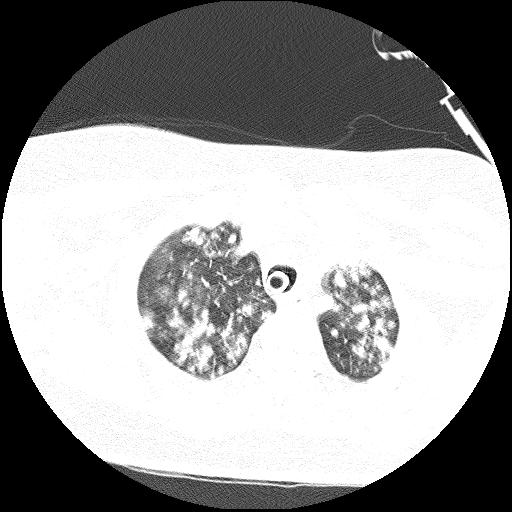 File:Cardiac angiosarcoma (Radiopaedia 66010-75181 Axial lung window 77).jpg