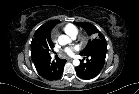 Cardiac sarcoidosis (Radiopaedia 74548-85534 A 43).jpg