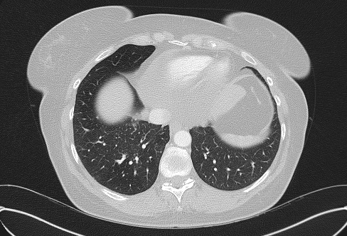 Cardiac sarcoidosis (Radiopaedia 74548-85534 Axial lung window 69).jpg