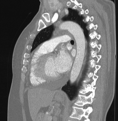 Cardiac sarcoidosis (Radiopaedia 74548-85534 Sagittal lung window 39).jpg