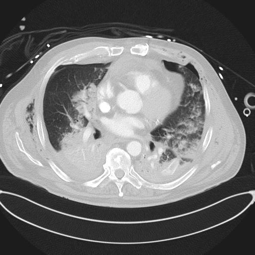 File:Cardiac trauma (Radiopaedia 32874-33858 Axial lung window 30).jpg