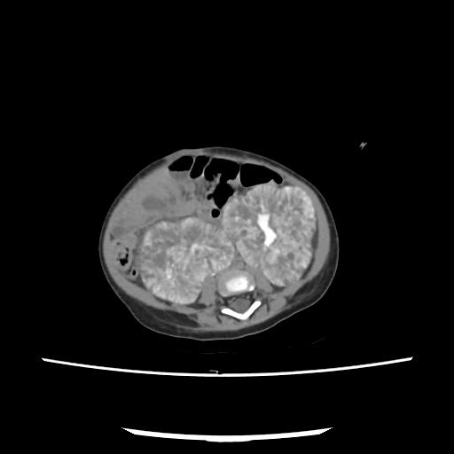 Caroli disease with autosomal recessive polycystic kidney disease (ARPKD) (Radiopaedia 89651-106703 E 154).jpg