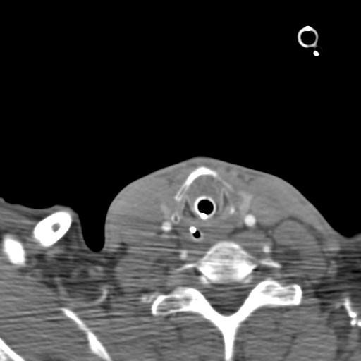 Carotid arterial dissection (Radiopaedia 30001-30548 B 38).jpg