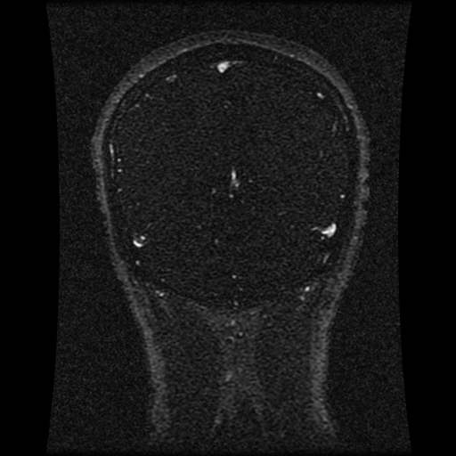 Carotid arterial dissection with acute cerebral infarction (Radiopaedia 26636-26784 MRV 62).jpg