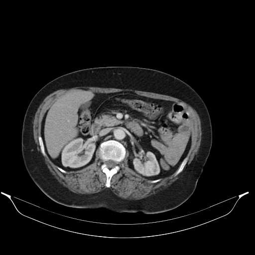 File:Carotid body tumor (Radiopaedia 21021-20948 A 62).jpg