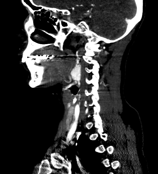 File:Carotid body tumor (Radiopaedia 39845-42300 D 53).jpg