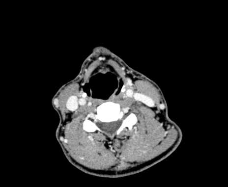 Carotid body tumor (Radiopaedia 61750-69757 Axial Post contrast 68).jpg