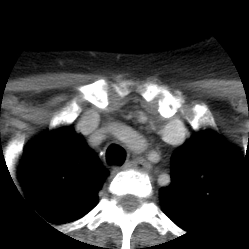 Carotid body tumor (paraganglioma) (Radiopaedia 38586-40729 A 32).jpg