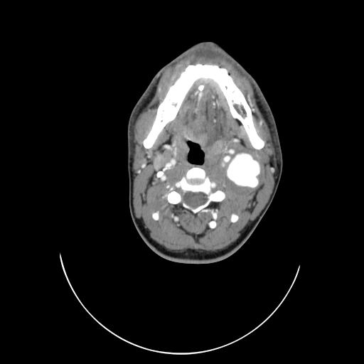 File:Carotid bulb pseudoaneurysm (Radiopaedia 57670-64616 A 25).jpg