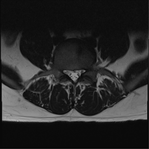 File:Cauda equina syndrome (Radiopaedia 53615-59672 Axial T2 11).png
