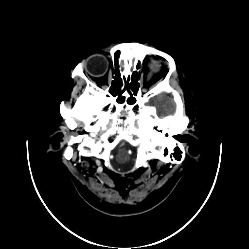 File:Cavernoma with developmental venous anomaly (Radiopaedia 22470-22506 C+ arterial phase 2).jpg