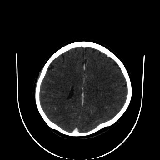 Cavernoma with developmental venous anomaly (Radiopaedia 22470-22506 C 124).jpg