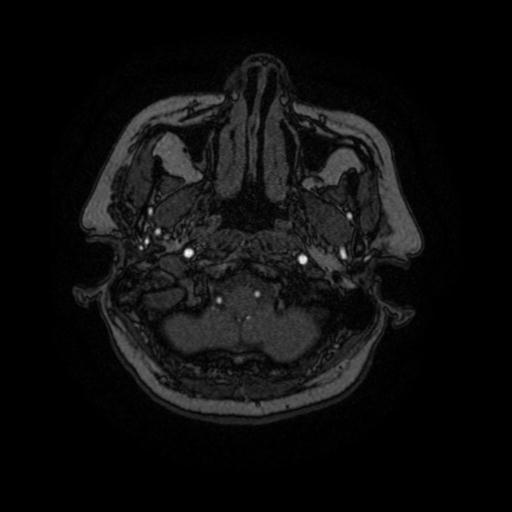Cavernoma with developmental venous anomaly (Radiopaedia 22470-22507 MRA 95).jpg