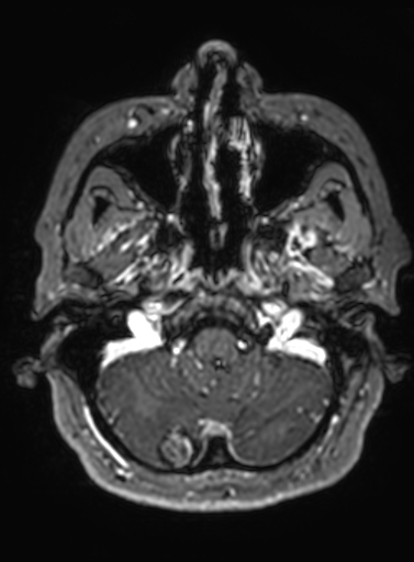 Cavernous hemangioma of the cerebellar falx (Radiopaedia 73025-83724 Axial T1 C+ 287).jpg