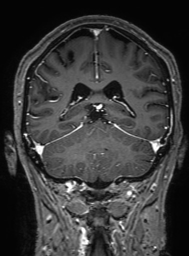 Cavernous hemangioma of the cerebellar falx (Radiopaedia 73025-83724 Coronal T1 C+ 253).jpg