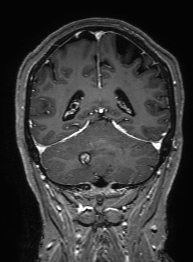 Cavernous hemangioma of the cerebellar falx (Radiopaedia 73025-83724 Coronal T1 C+ 270).jpg