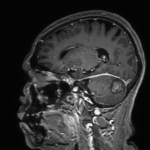 File:Cavernous hemangioma of the cerebellar falx (Radiopaedia 73025-83724 Sagittal T1 C+ 79).jpg