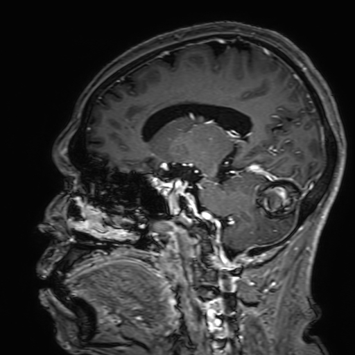 Cavernous hemangioma of the cerebellar falx (Radiopaedia 73025-83724 Sagittal T1 C+ 87).jpg