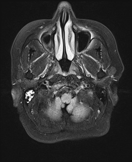 File:Cavernous sinus meningioma (Radiopaedia 63682-72367 Axial FLAIR 3).jpg