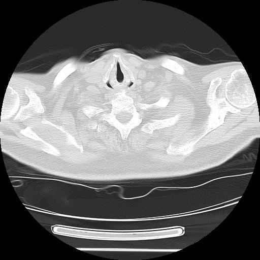 Cavitating pulmonary metastases (Radiopaedia 89545-106544 Axial lung window 1).jpg