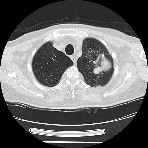 File:Cavitating pulmonary metastases (Radiopaedia 89545-106544 Axial lung window 10).jpg