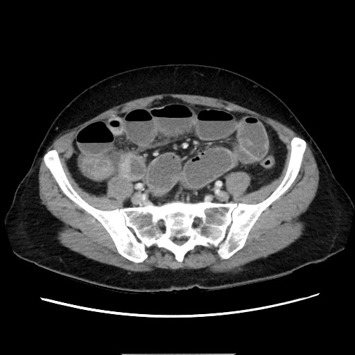 Cecal adenocarcinoma (Radiopaedia 75909-87331 A 66).jpg