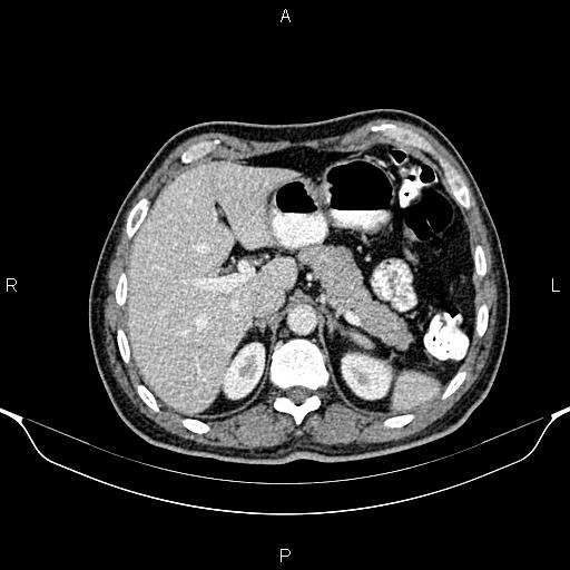 Cecal adenocarcinoma (Radiopaedia 85324-100916 B 22).jpg