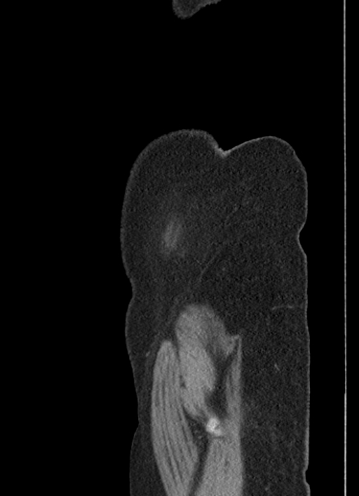 Cecal adenocarcinoma - surgical scar recurrence (Radiopaedia 79988-93264 D 65).jpg