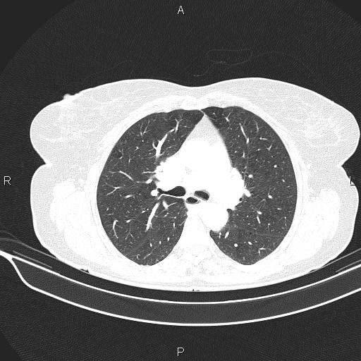 Cecal cancer (Radiopaedia 85610-101358 Axial lung window 27).jpg