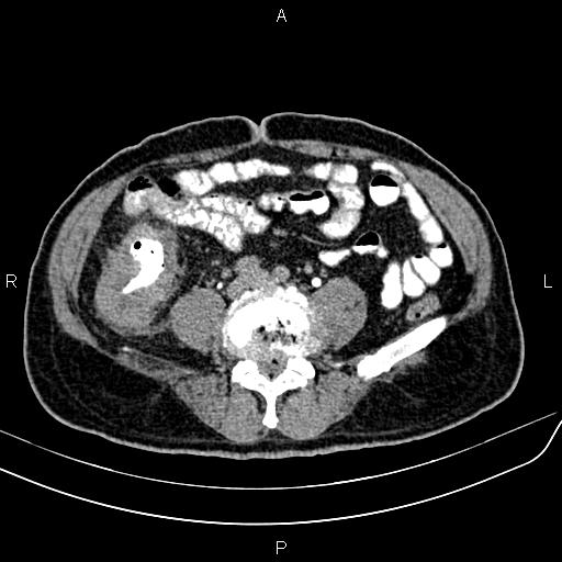 File:Cecal cancer with appendiceal mucocele (Radiopaedia 91080-108651 Axial C+ delayed 47).jpg