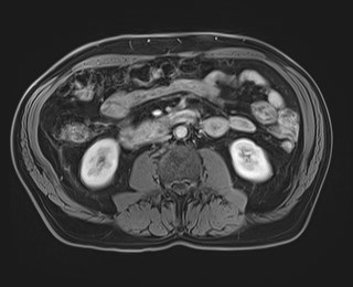 Cecal mass causing appendicitis (Radiopaedia 59207-66532 T1 C+ PV phase 71).jpg