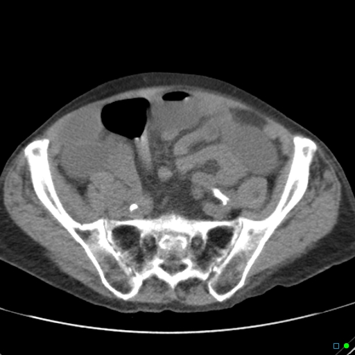 Cecal volvulus - atypical (Radiopaedia 21637-21588 non-contrast 53).jpg