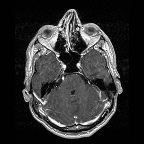 Central-variant posterior reversible encephalopathy syndrome (PRES) (Radiopaedia 43880-47358 Axial T1 C+ 39).jpg