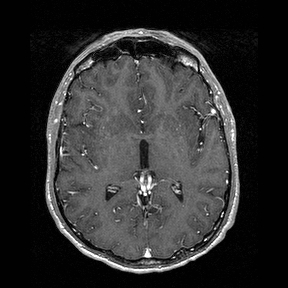 Central-variant posterior reversible encephalopathy syndrome (PRES) (Radiopaedia 43880-47358 Axial T1 C+ 81).jpg