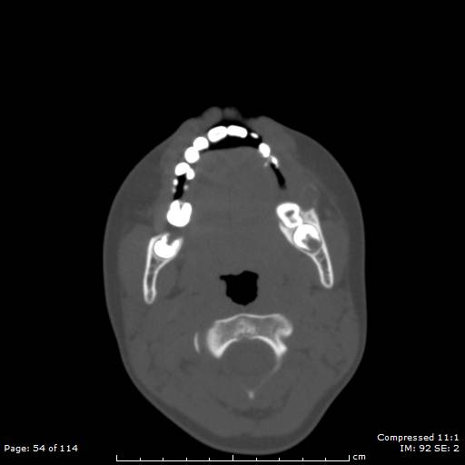 File:Central giant cell granuloma (Radiopaedia 45612-49754 Axial bone window 27).jpg