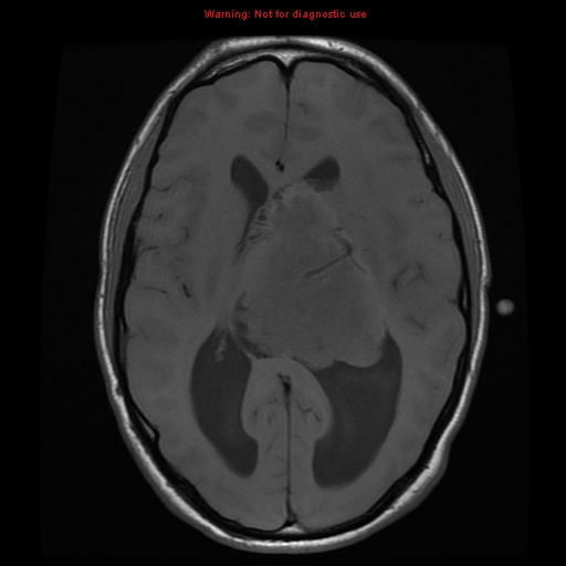 File:Central neurocytoma (Radiopaedia 13188-13206 Axial T1 3).jpg