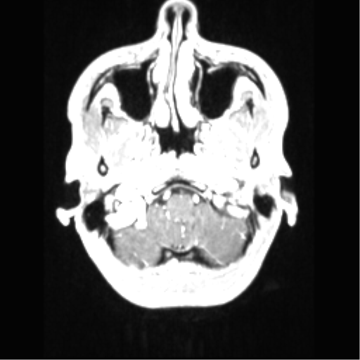 File:Central neurocytoma (Radiopaedia 37664-39557 Axial T1 C+ 12).png