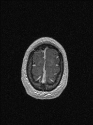 Central neurocytoma (Radiopaedia 56690-63469 Axial T1 C+ 150).jpg