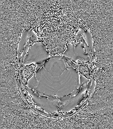 Central neurocytoma (Radiopaedia 84497-99872 Axial 20).jpg