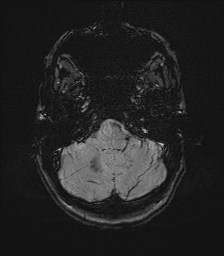 Central neurocytoma (Radiopaedia 84497-99872 Axial SWI 13).jpg