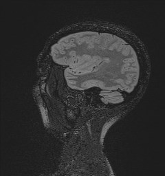 Central neurocytoma (Radiopaedia 84497-99872 Sagittal Flair + Gd 39).jpg