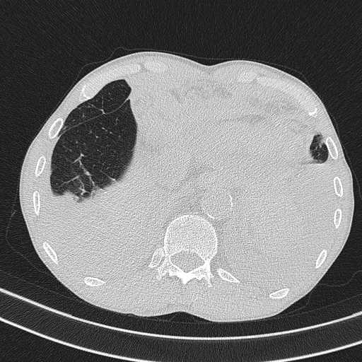 Central venous catheter tip extravasation (Radiopaedia 82828-97113 Axial lung window 72).jpg