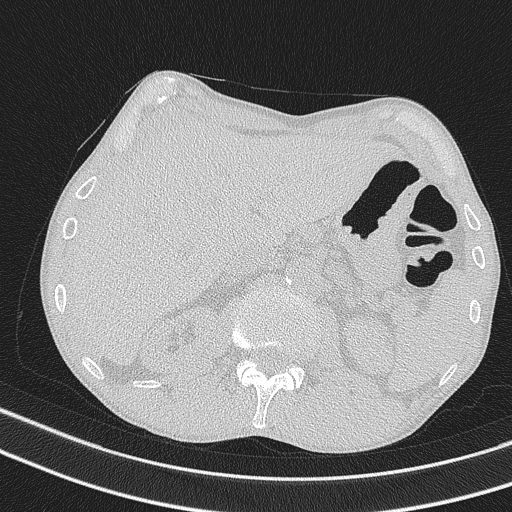 Central venous catheter tip extravasation (Radiopaedia 82828-97113 Axial lung window 83).jpg